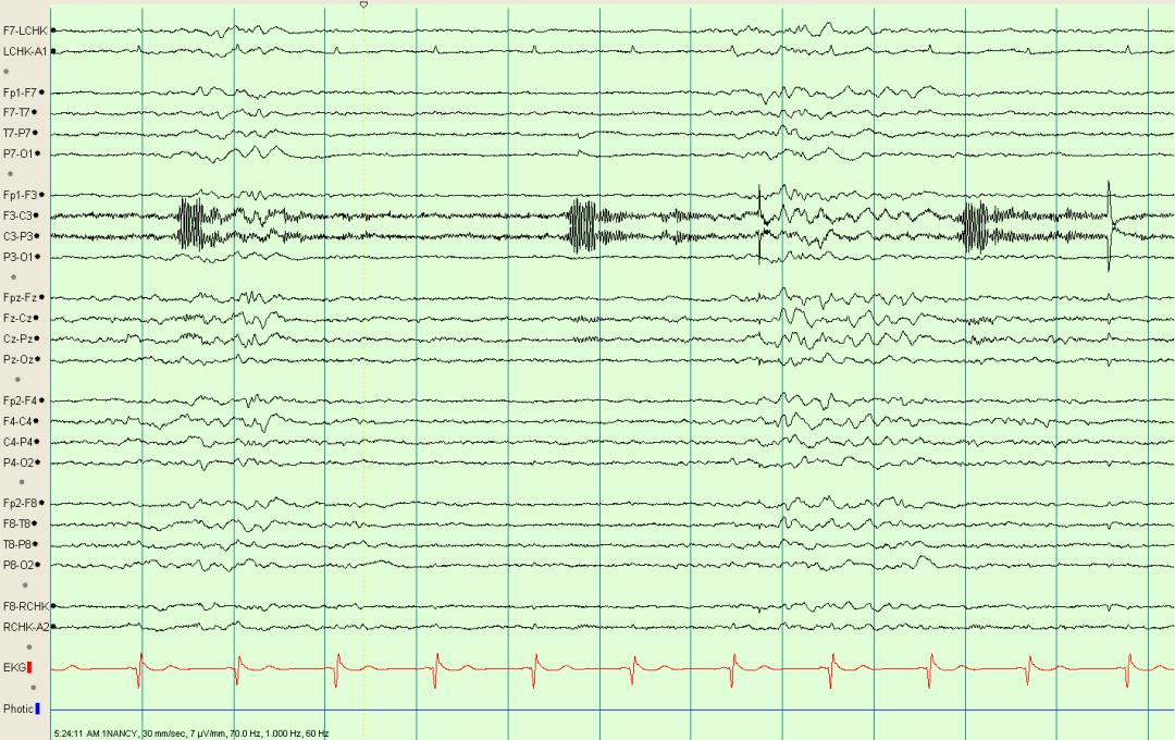 脑电图伪差图,脑电图伪差图谱