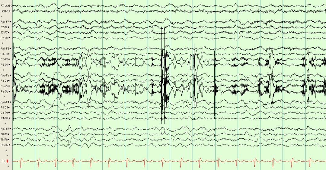 脑电图伪差图,脑电图伪差图谱