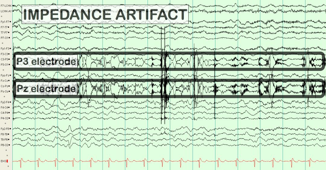 脑电图伪差图,脑电图伪差图谱