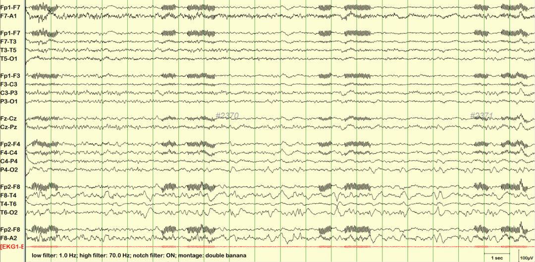 脑电图伪差图,脑电图伪差图谱