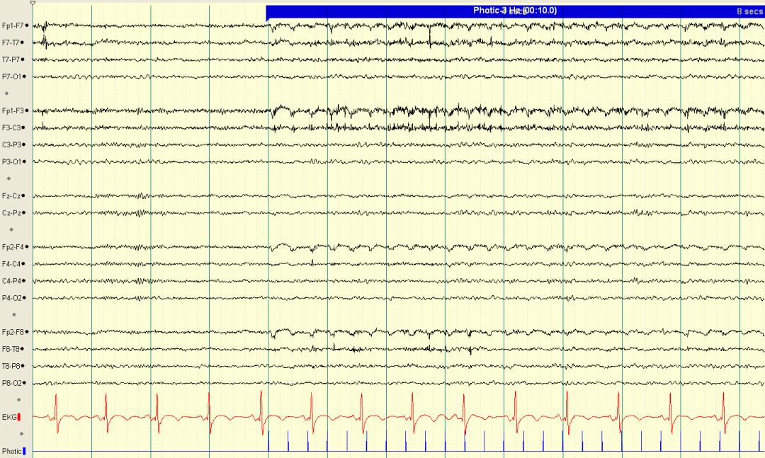 脑电图伪差图,脑电图伪差图谱