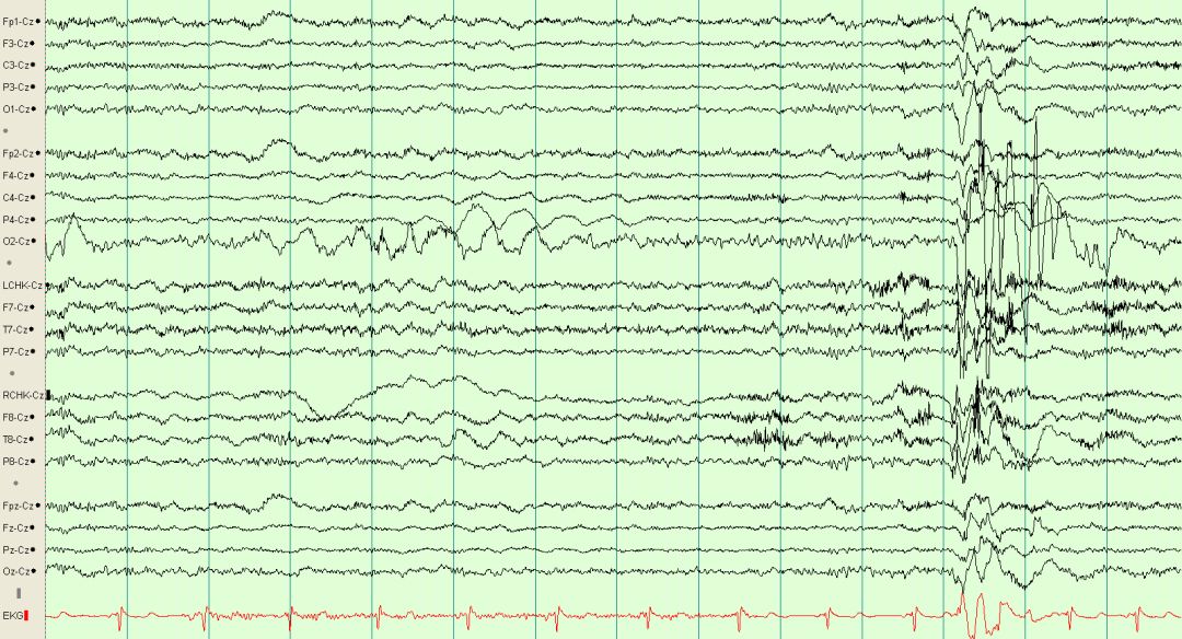 脑电图伪差图,脑电图伪差图谱