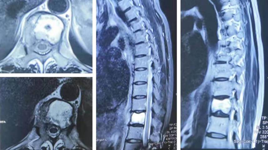 胸椎瘤手术,胸椎旁肿瘤手术成功率