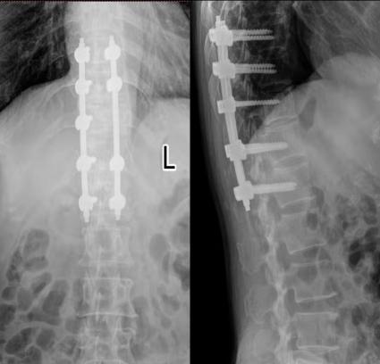 胸椎瘤手术,胸椎旁肿瘤手术成功率