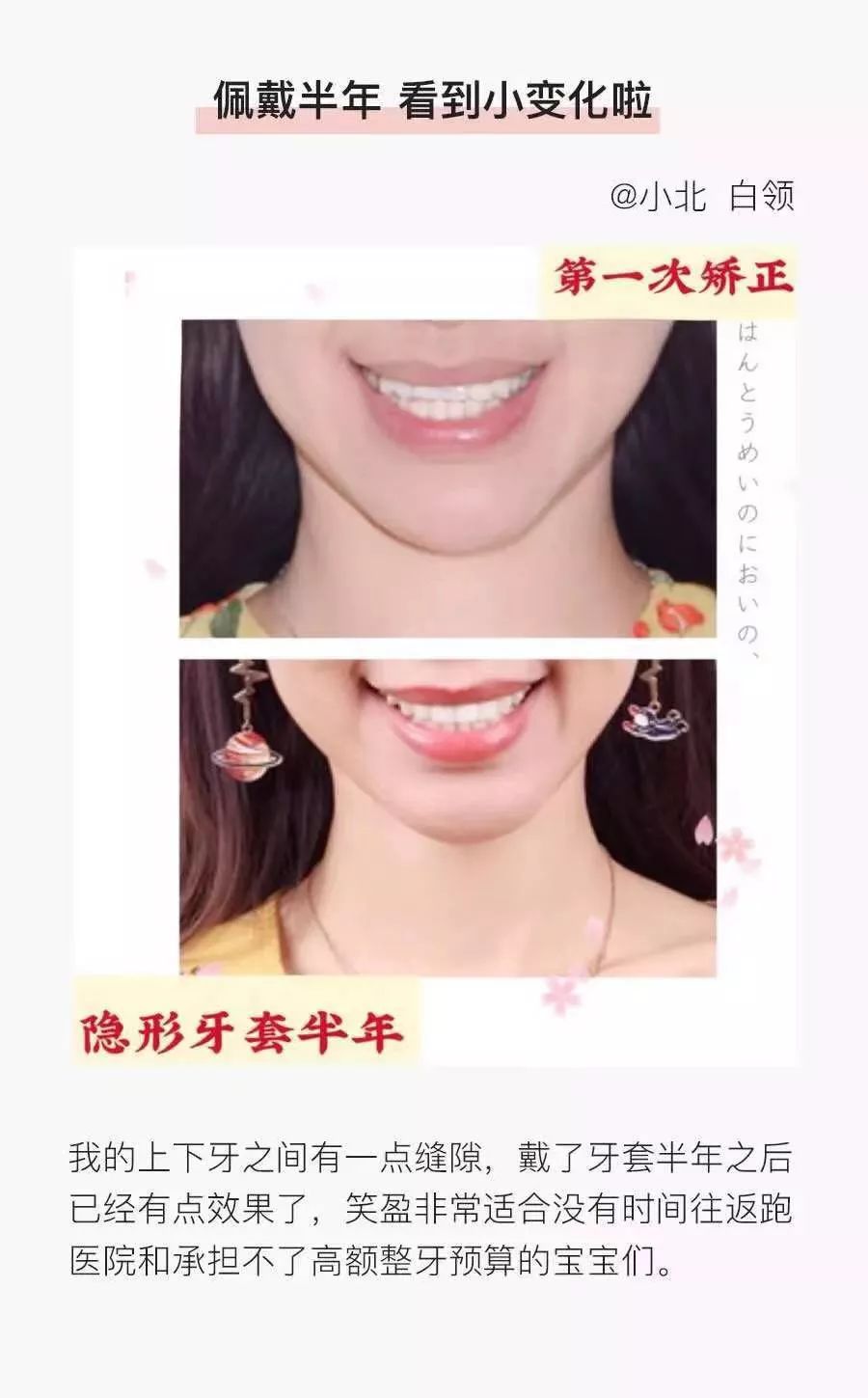 牙齿缝隙大隐形牙套矫正前后对比,牙齿前突隐形牙套矫正的全过程