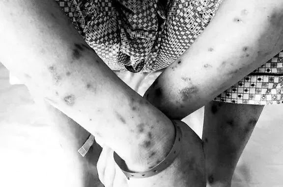 吸毒容易感染艾滋病的原因,吸毒传染艾滋病的风险不高