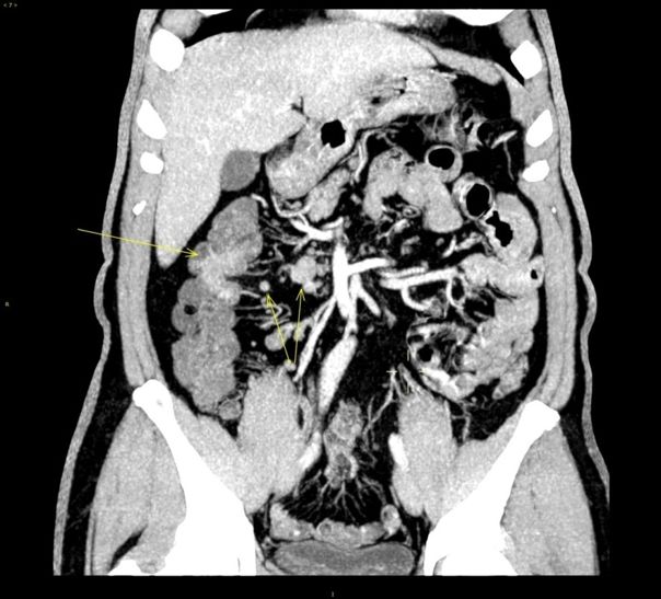 升结肠癌肝转移,如何实现治愈“神话”?|病例分享
