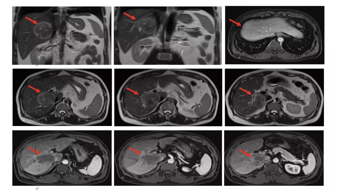 升结肠癌肝转移，如何实现治愈“神话”？|病例分享