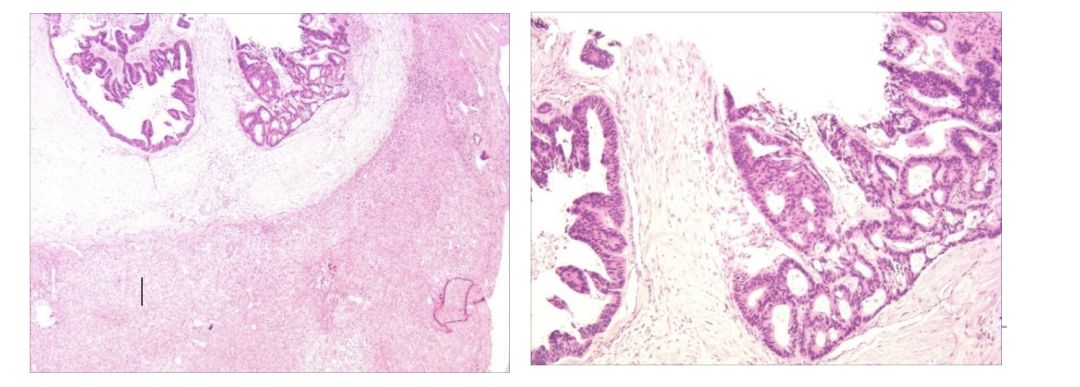 升结肠癌肝转移，如何实现治愈“神话”？|病例分享