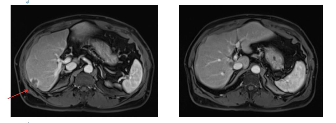 升结肠癌肝转移,如何实现治愈“神话”?|病例分享