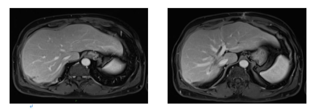 升结肠癌肝转移,如何实现治愈“神话”?|病例分享