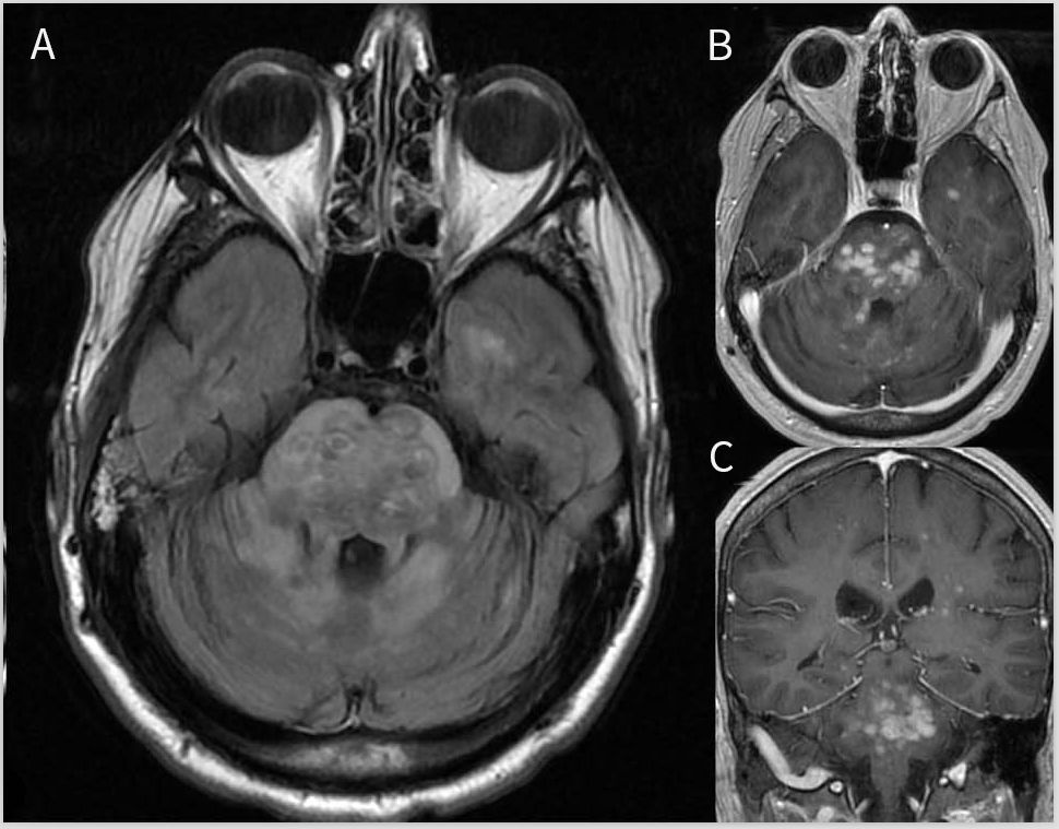 脑干炎症主要症状,脑干炎症临床表现