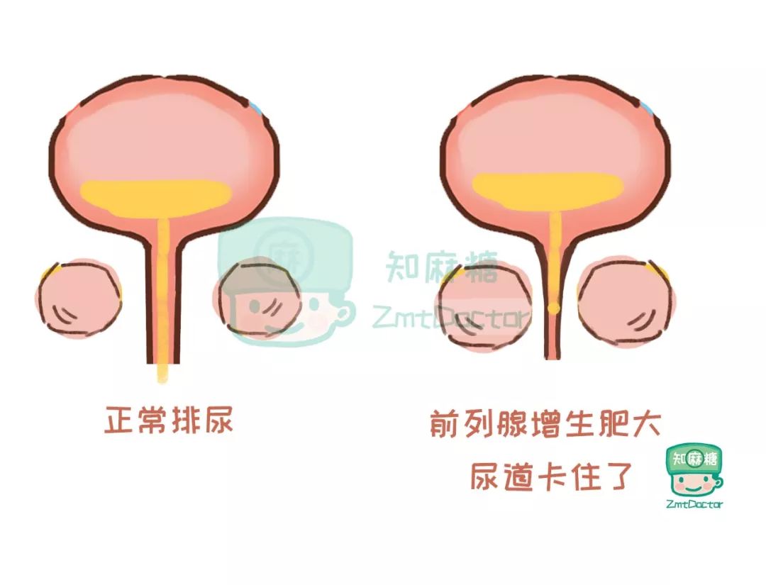 你居然以为尿是这么吸出来的