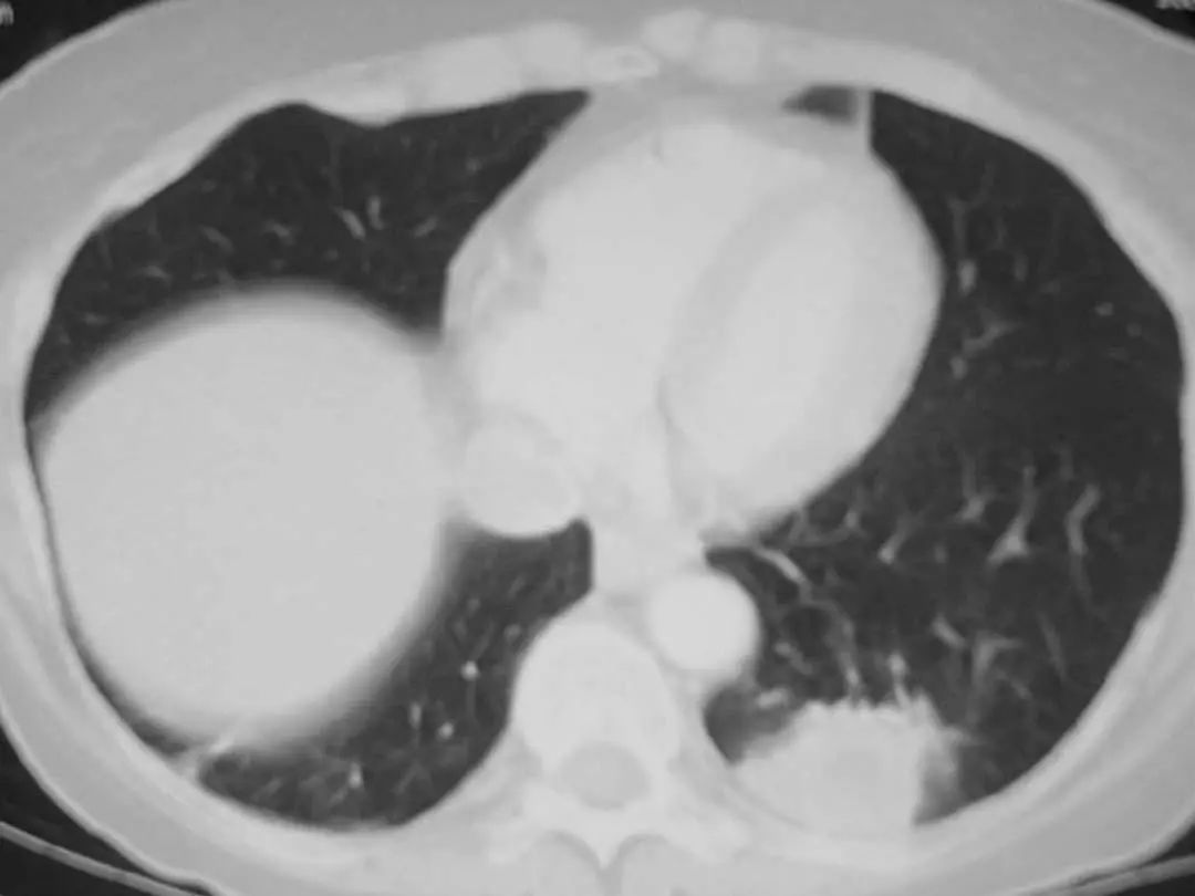 26张图，搞懂细菌性肺炎与病毒性肺炎