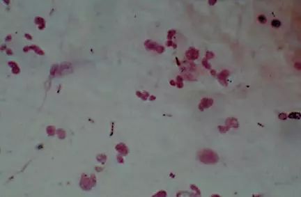 26张图，搞懂细菌性肺炎与病毒性肺炎