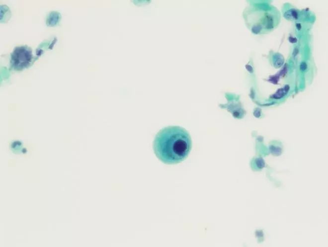 26张图，搞懂细菌性肺炎与病毒性肺炎