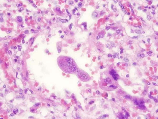 26张图，搞懂细菌性肺炎与病毒性肺炎