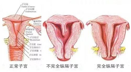 雅安恒博医院提醒：子宫有这道“墙”需及时“拆除”