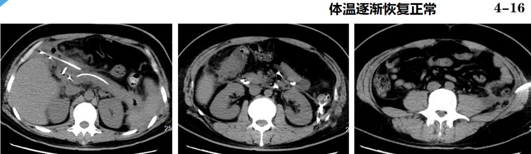急性重症胰腺炎治疗八步骤,急性胰腺炎恐惧的护理措施