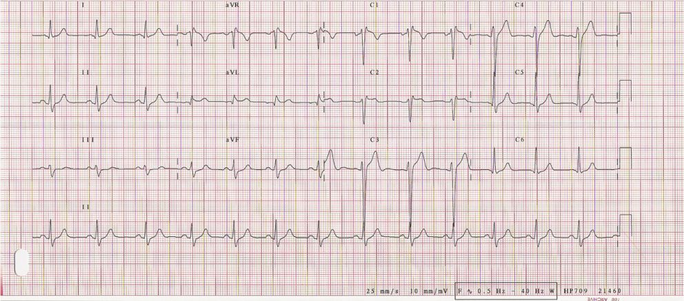 致命胸痛的10个常见部位,致命性胸痛的常见病因有哪些