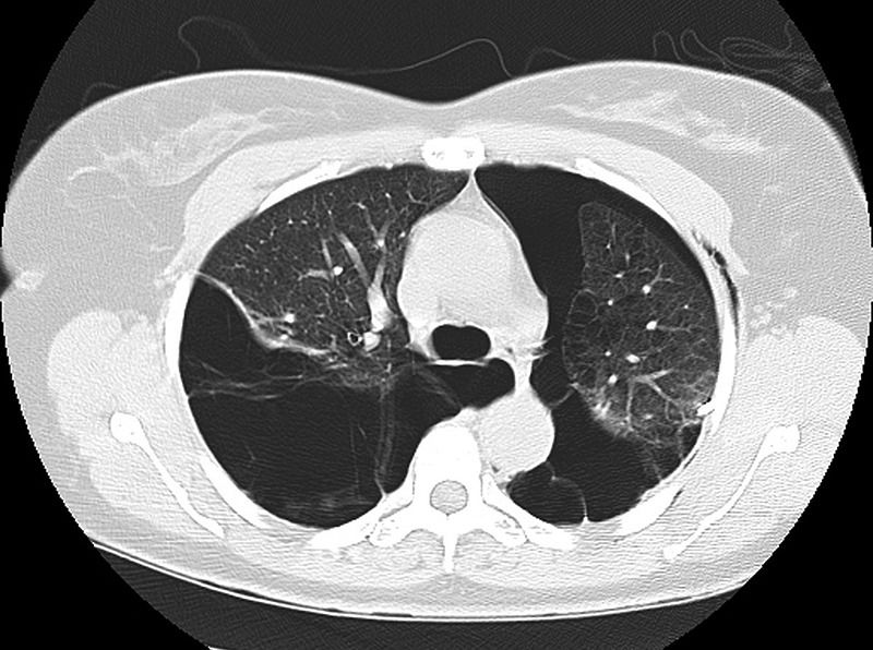 致命胸痛的10个常见部位,致命性胸痛的常见病因有哪些