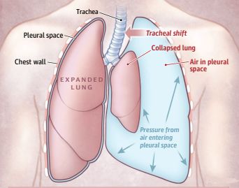 致命胸痛的10个常见部位,致命性胸痛的常见病因有哪些