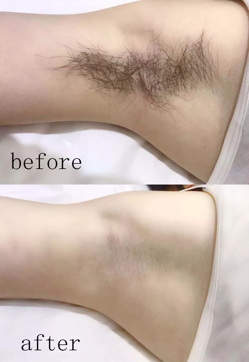 脱毛轻轻松松告别夏日尴尬,脱毛最好的季节