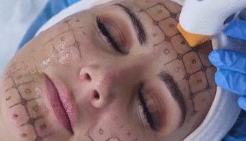 热玛吉抗衰老手术适应6类人群,了解热玛吉抗衰老看这篇就够了