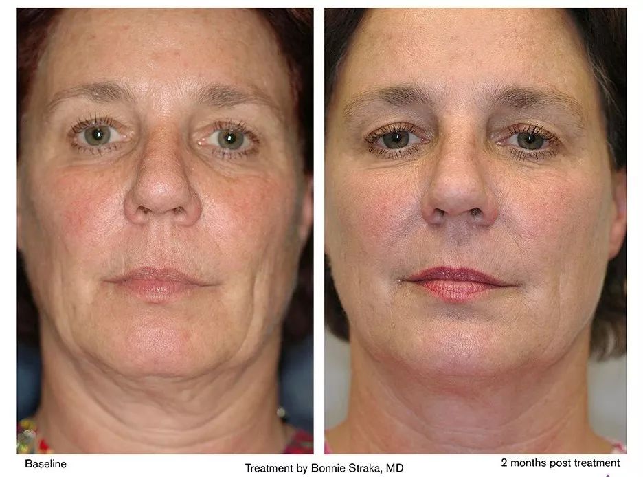 热玛吉抗衰老手术适应6类人群,了解热玛吉抗衰老看这篇就够了