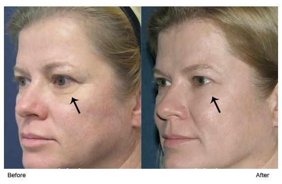 热玛吉抗衰老手术适应6类人群,了解热玛吉抗衰老看这篇就够了