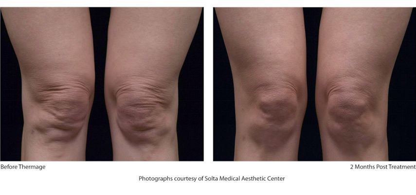 热玛吉抗衰老手术适应6类人群,了解热玛吉抗衰老看这篇就够了