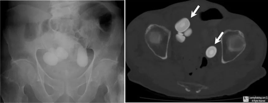 膀胱结石影像,描述膀胱结石在b超中的影像表现