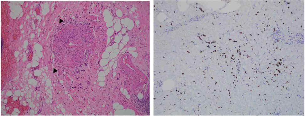 输尿管肿瘤淋巴结转移,肿瘤患者输尿管放支架以后怎么办