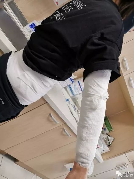 女子拔火罐胳膊烧伤,女明星拔火罐疼得要哭