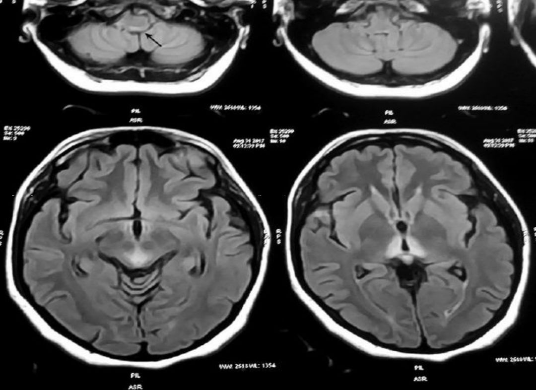 甲硝唑中毒脑病治疗,甲硝唑脑梗