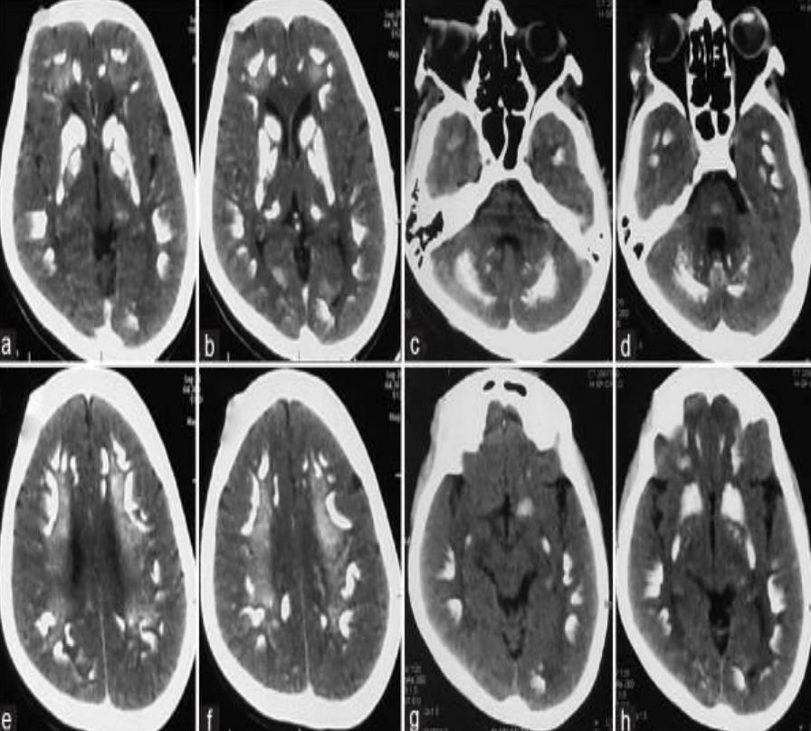 甲硝唑中毒脑病治疗,甲硝唑脑梗