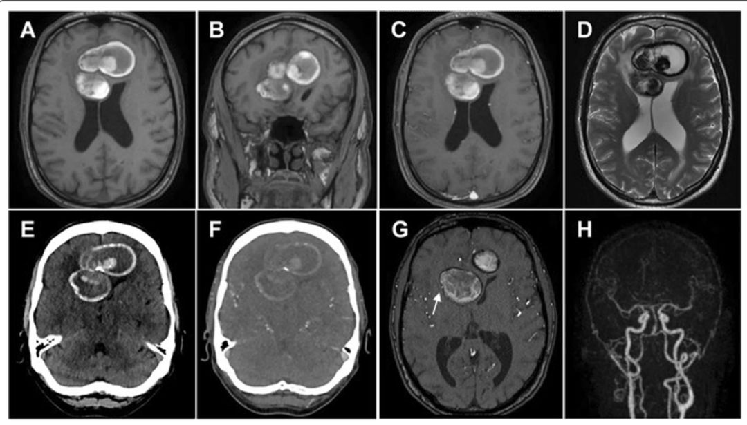 甲硝唑中毒脑病治疗,甲硝唑脑梗