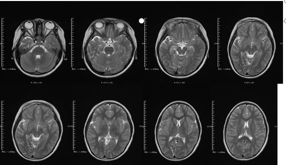 甲硝唑中毒脑病治疗,甲硝唑脑梗
