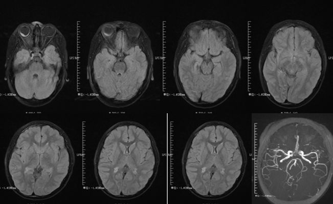 甲硝唑中毒脑病治疗,甲硝唑脑梗