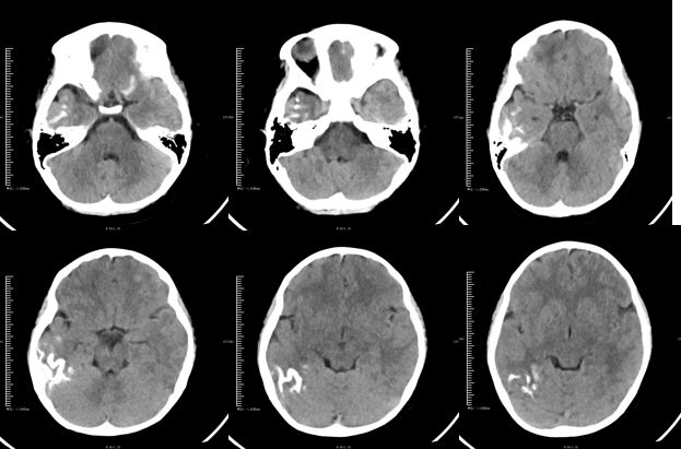 甲硝唑中毒脑病治疗,甲硝唑脑梗