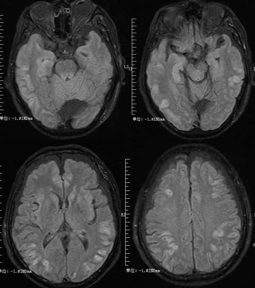 甲硝唑中毒脑病治疗,甲硝唑脑梗