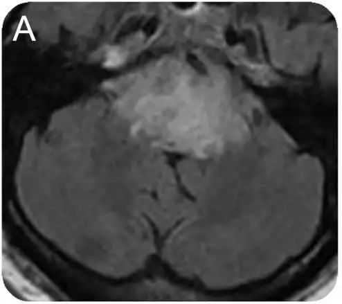 甲硝唑中毒脑病治疗,甲硝唑脑梗