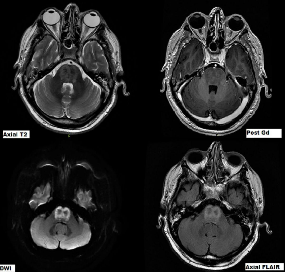 甲硝唑中毒脑病治疗,甲硝唑脑梗