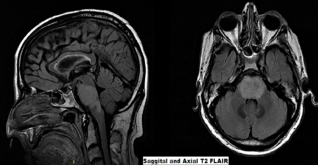 甲硝唑中毒脑病治疗,甲硝唑脑梗