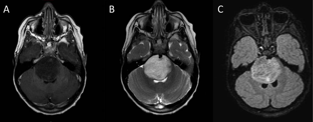 甲硝唑中毒脑病治疗,甲硝唑脑梗