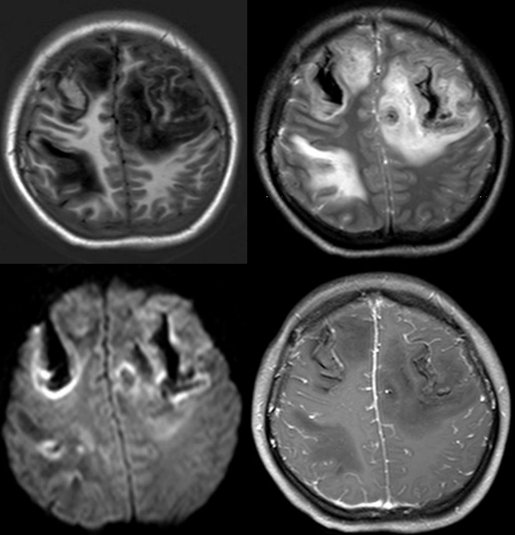 甲硝唑中毒脑病治疗,甲硝唑脑梗