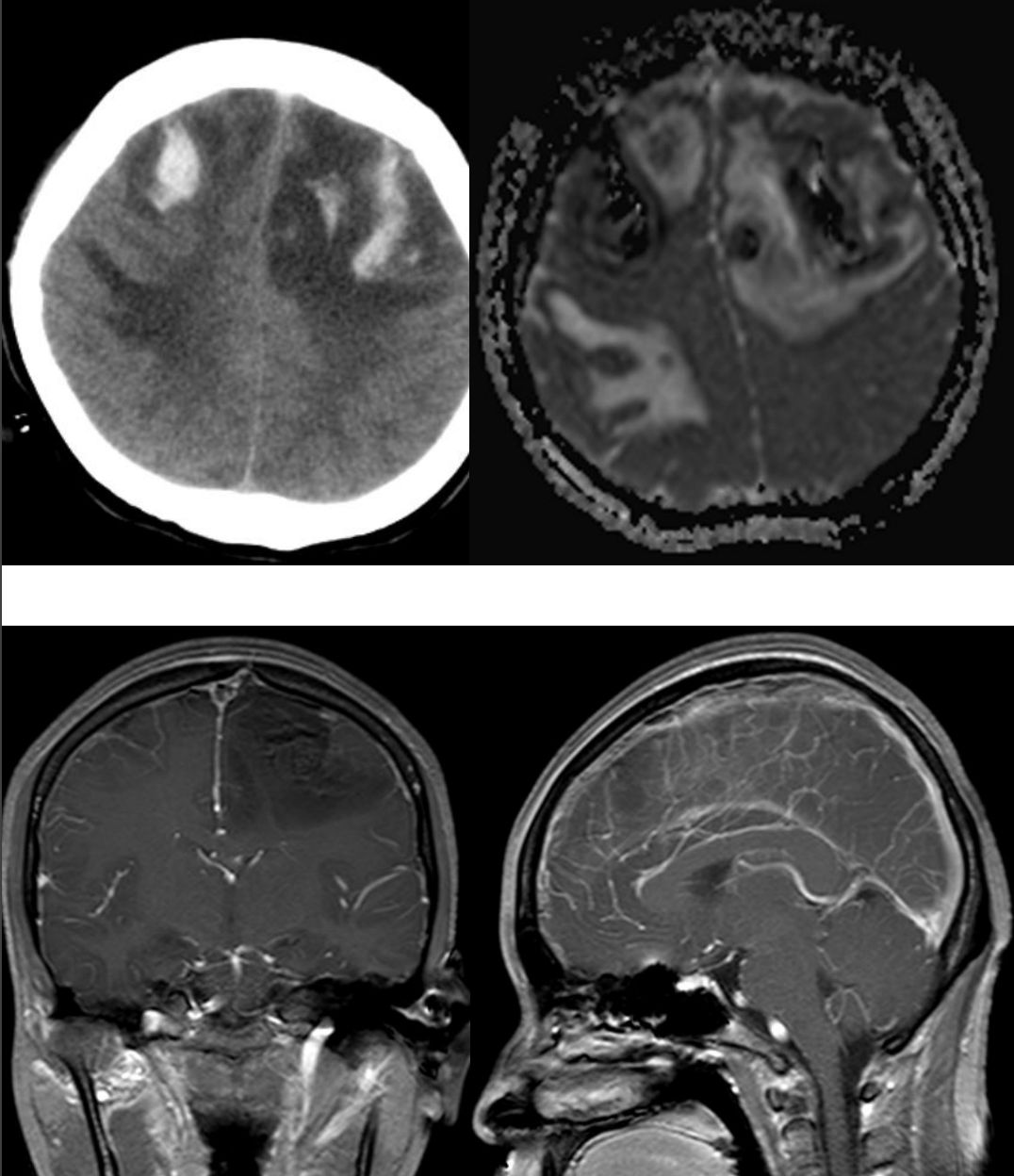 甲硝唑中毒脑病治疗,甲硝唑脑梗