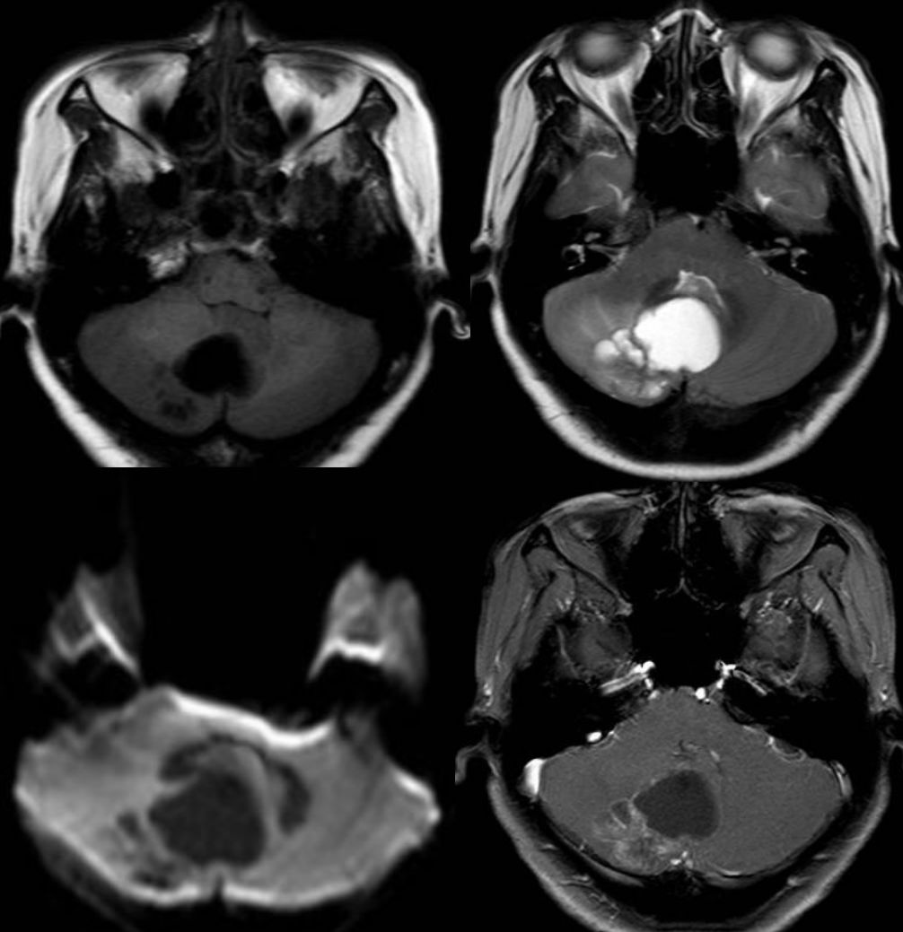 甲硝唑中毒脑病治疗,甲硝唑脑梗