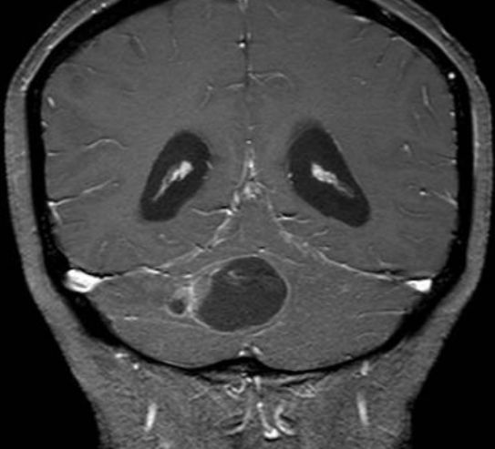 甲硝唑中毒脑病治疗,甲硝唑脑梗