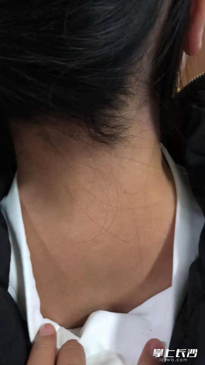 荨麻疹烫火锅,吃冒菜荨麻疹